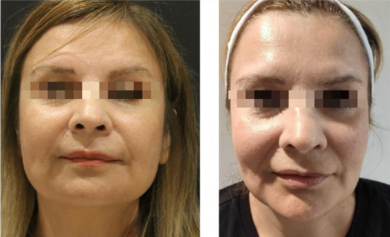 Before and After