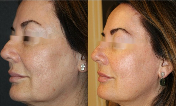 Before and After